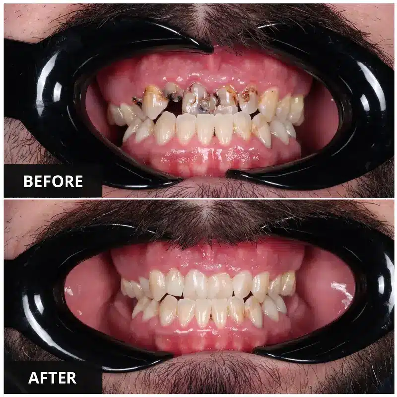 before-and-after-composite-bonding